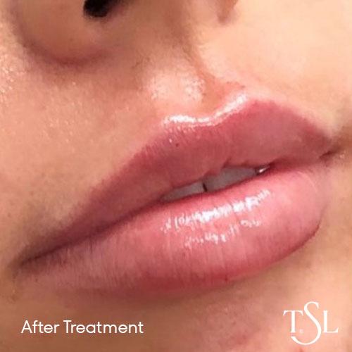 Before and after treatment with lips becoming more enhanced as a result of lip filler.