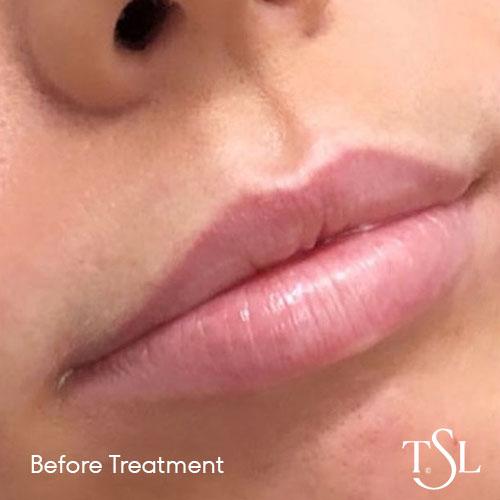 Before and after treatment with lips becoming more enhanced as a result of lip filler.