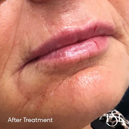 Before and after treatment with lips becoming more symmetrical after receiving The Skin Lab lip fillers in Brisbane.