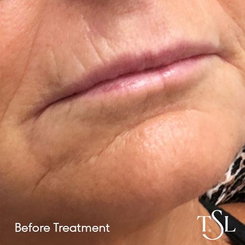 Before and after treatment with lips becoming more symmetrical after receiving The Skin Lab lip fillers in Brisbane.